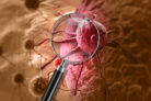Flavonoids and Cancer